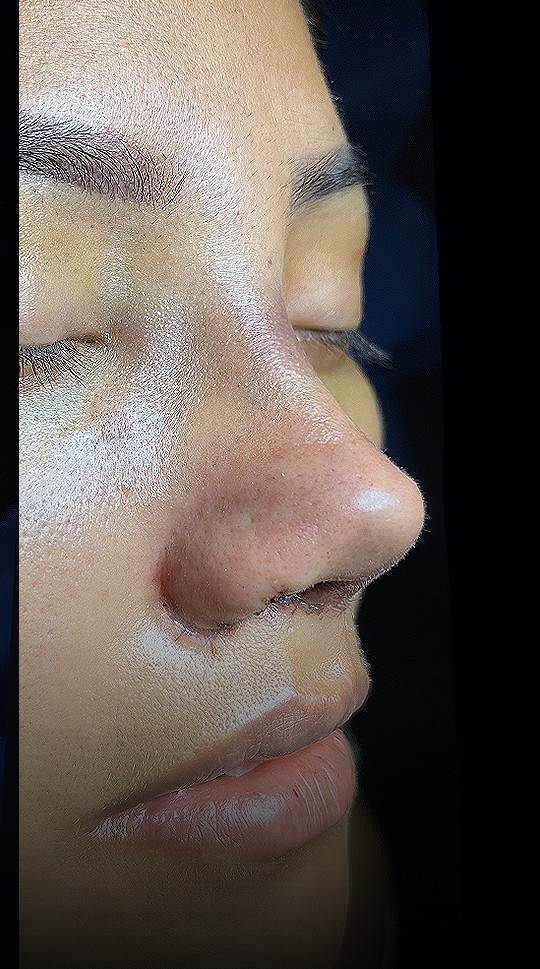 Comparación de perfil nasal antes y después del Caso 03 — después
