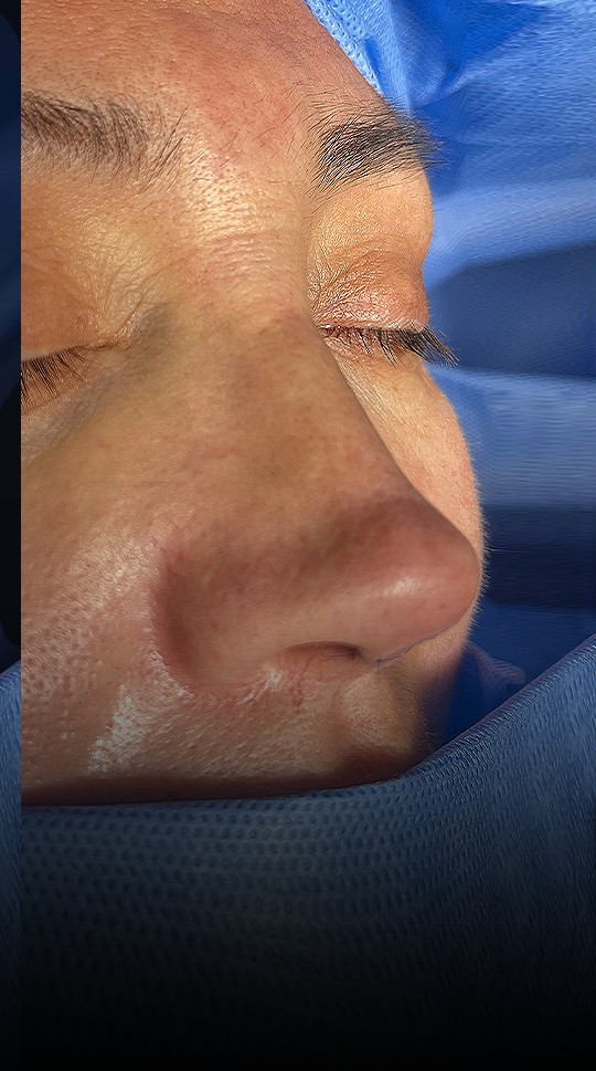 Comparación de perfil nasal antes y después del Caso 02 — después