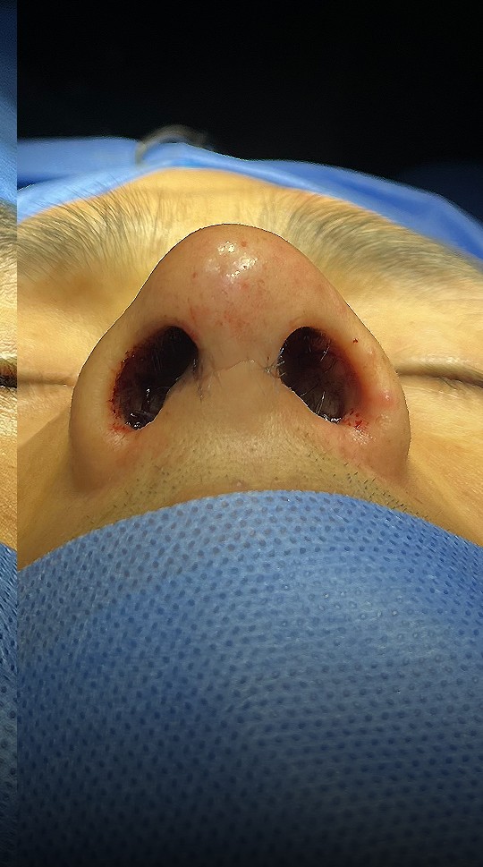 Comparación de perfil nasal antes y después del Caso 02 — después
