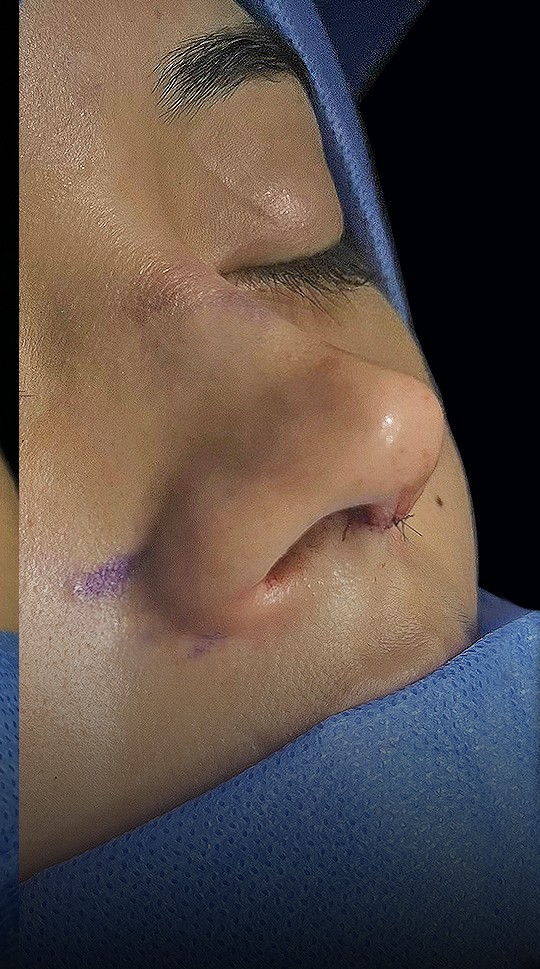 Comparación de perfil nasal antes y después del Caso 02 — después