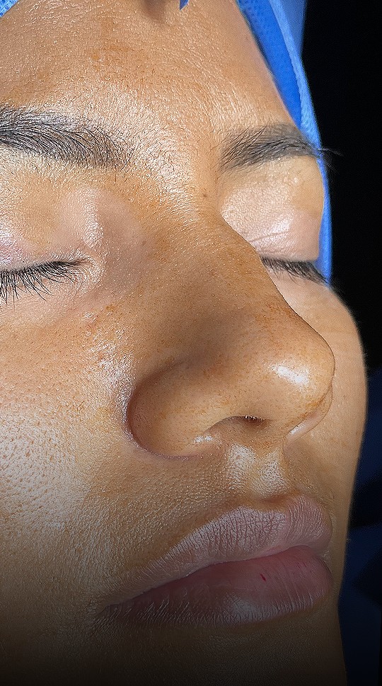 Comparación de perfil nasal antes y después del Caso 03 — antes