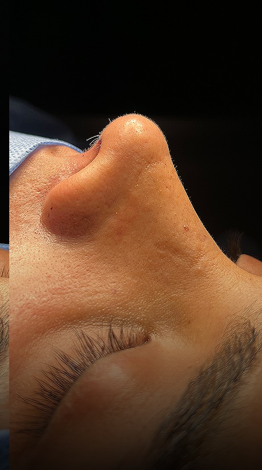Comparación de perfil nasal antes y después del Caso 01 — después