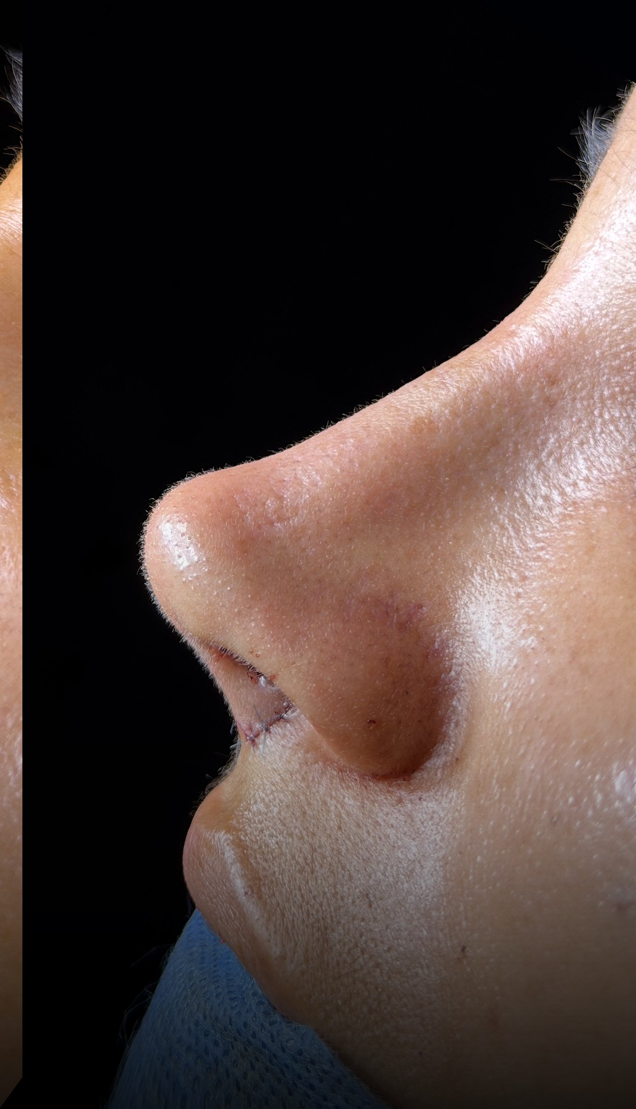 Comparación de perfil nasal antes y después del Caso 03 — después