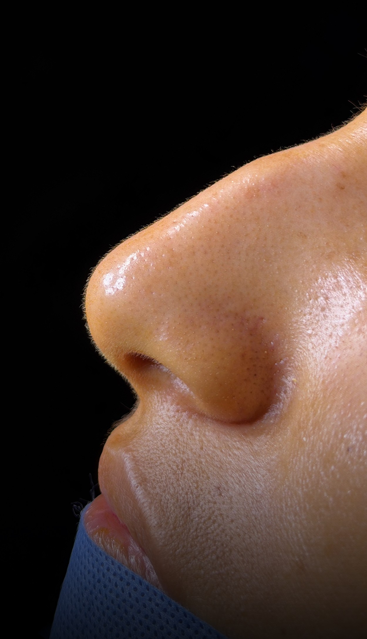 Comparación de perfil nasal antes y después del Caso 03 — antes