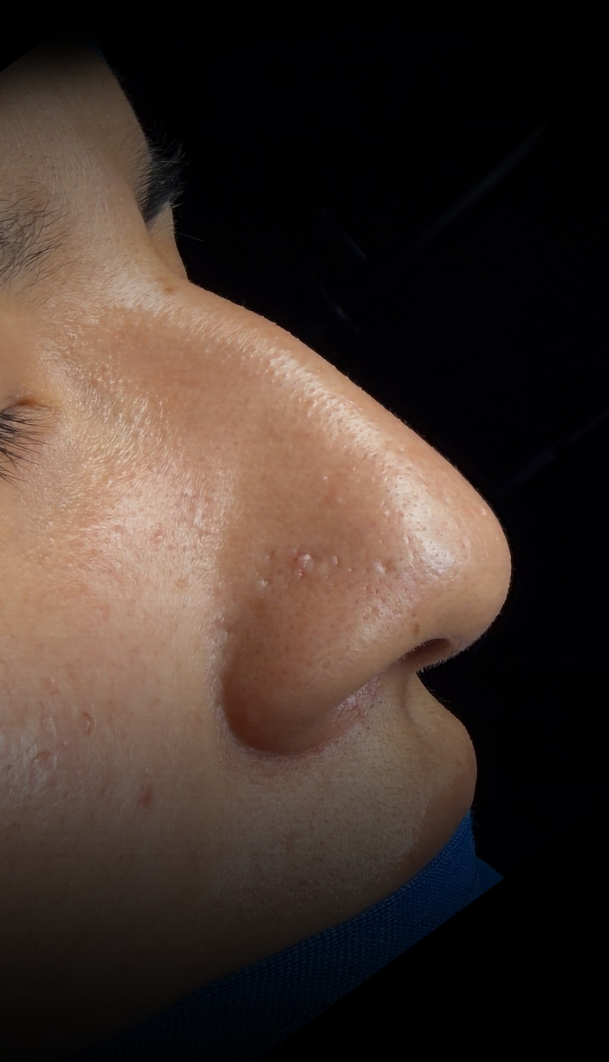 Comparación de perfil nasal antes y después del Caso 01 — antes
