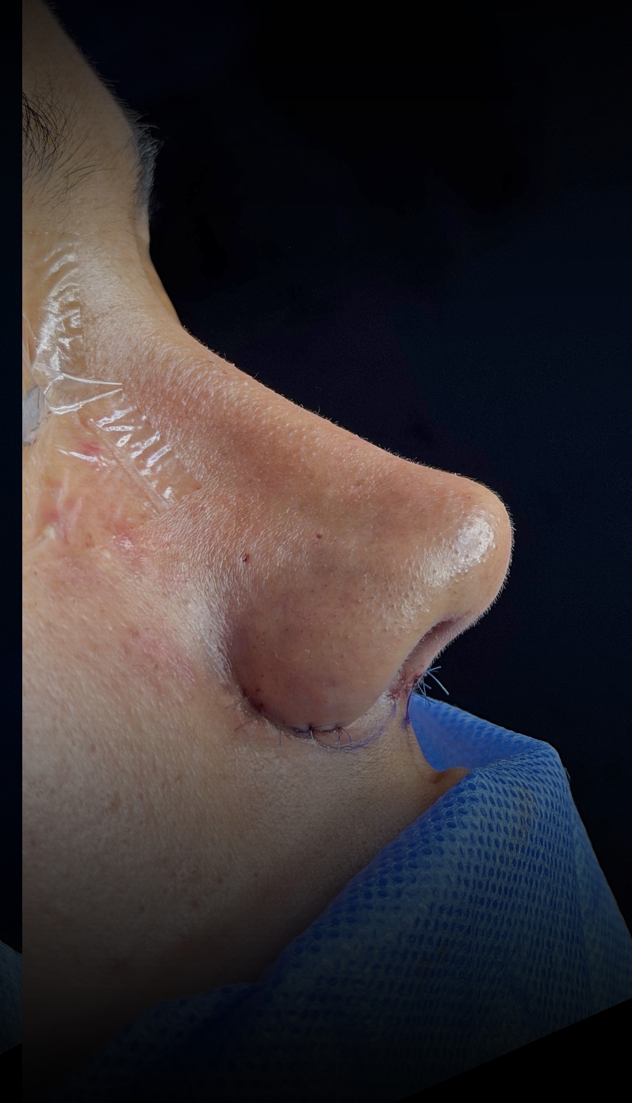 Comparación de perfil nasal antes y después del Caso 02 — después