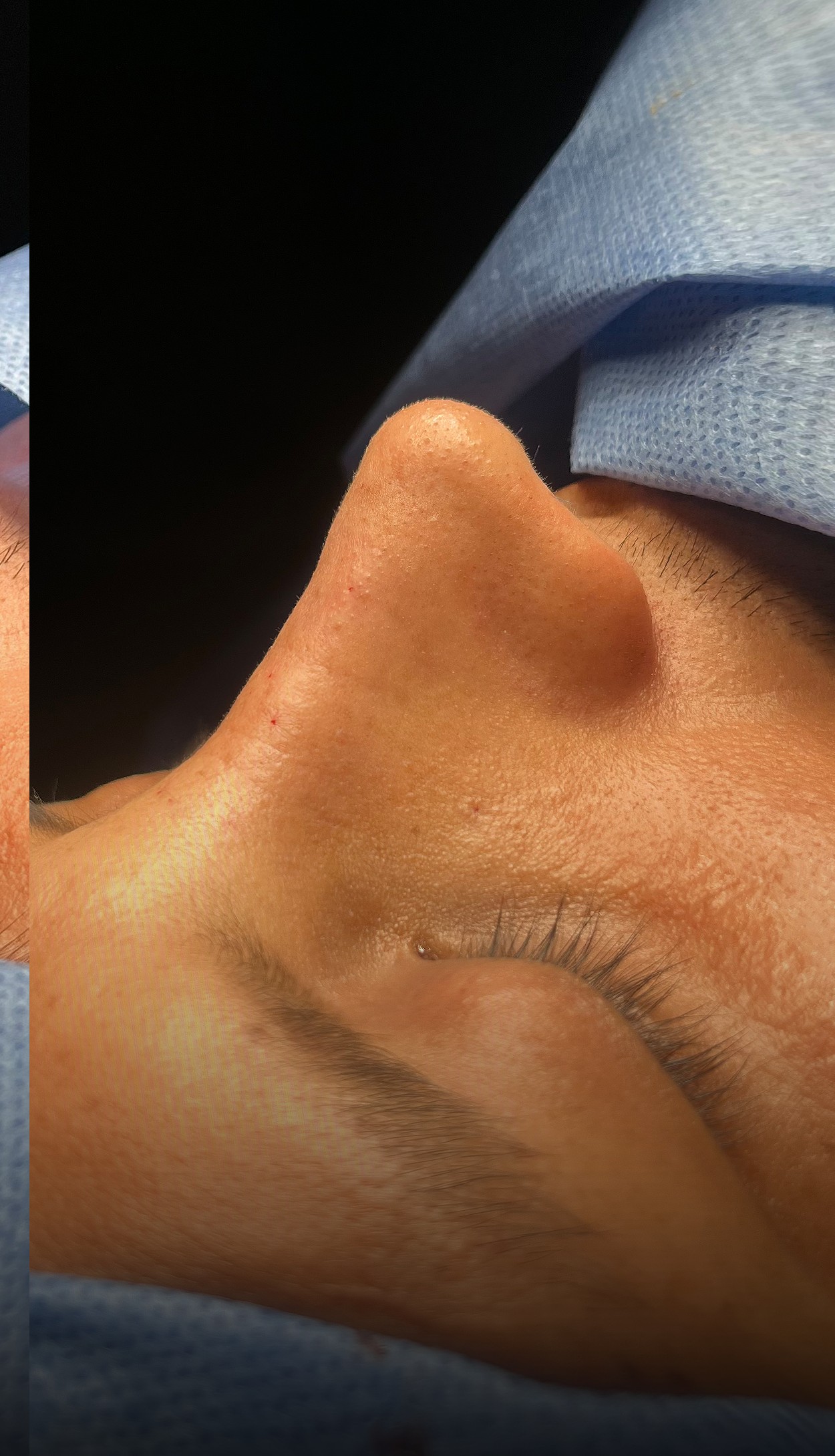 Comparación de perfil nasal antes y después del Caso 01 — después