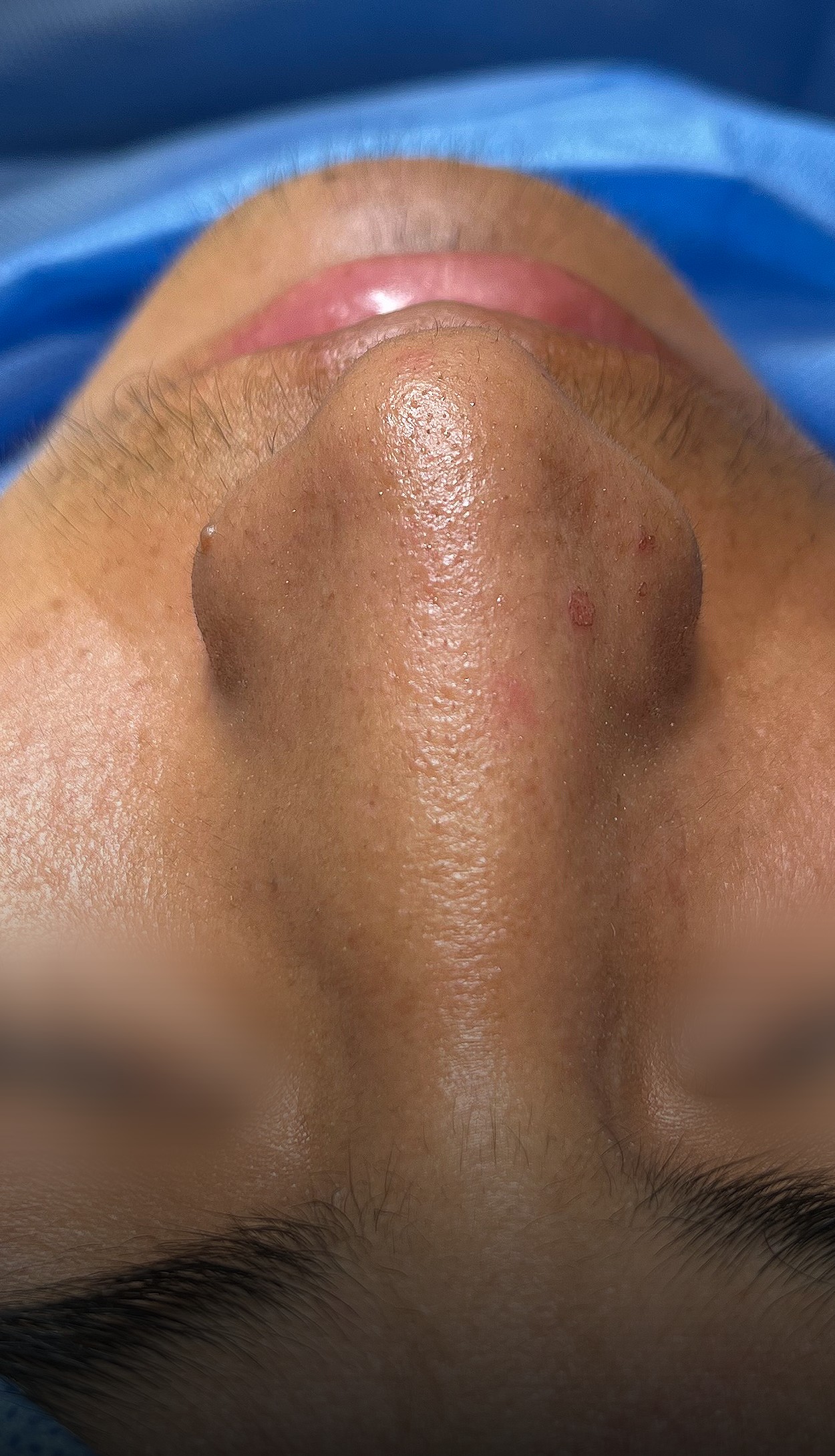 Comparación de perfil nasal antes y después del Caso 02 — antes