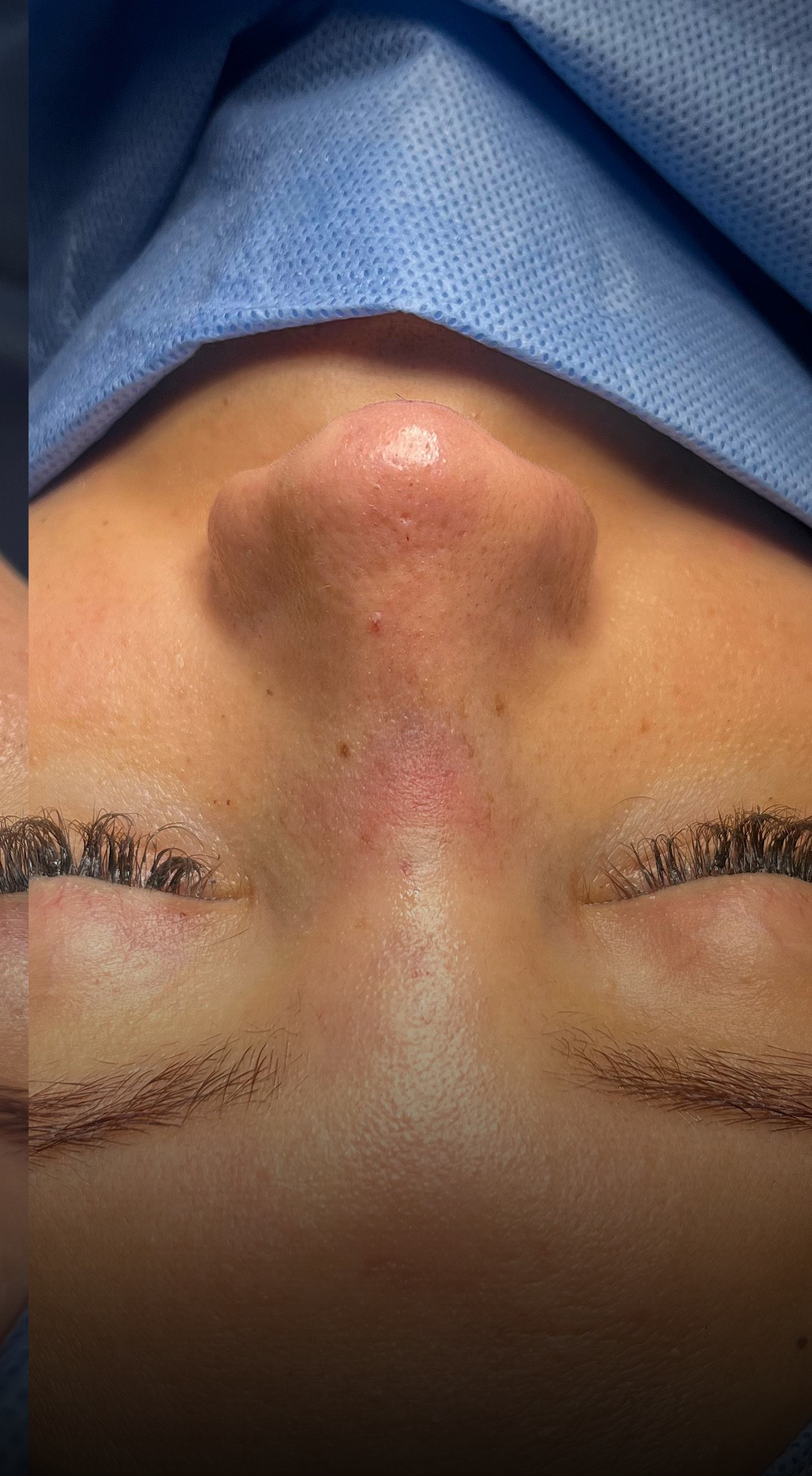 Comparación de perfil nasal antes y después del Caso 01 — después