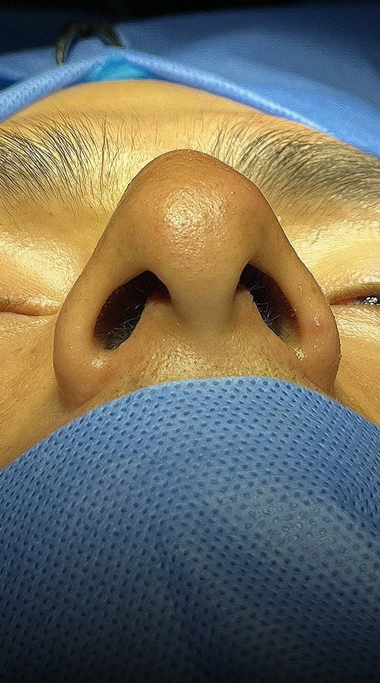 Comparación de perfil nasal antes y después del Caso 02 — antes