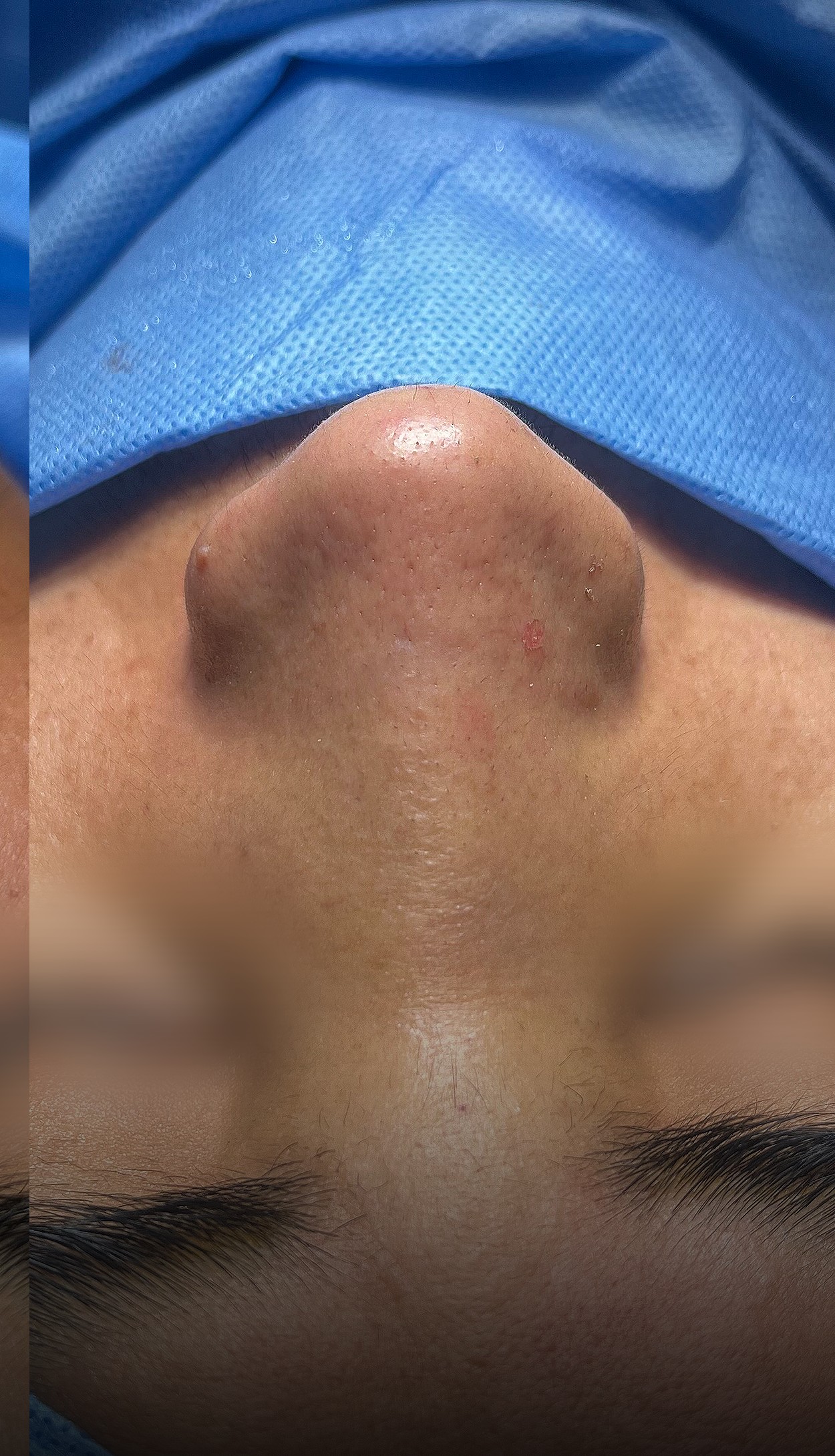 Comparación de perfil nasal antes y después del Caso 02 — después