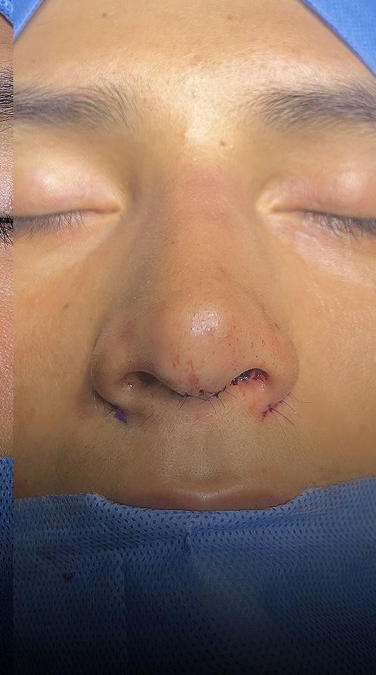 Comparación de perfil nasal antes y después del Caso 03 — después