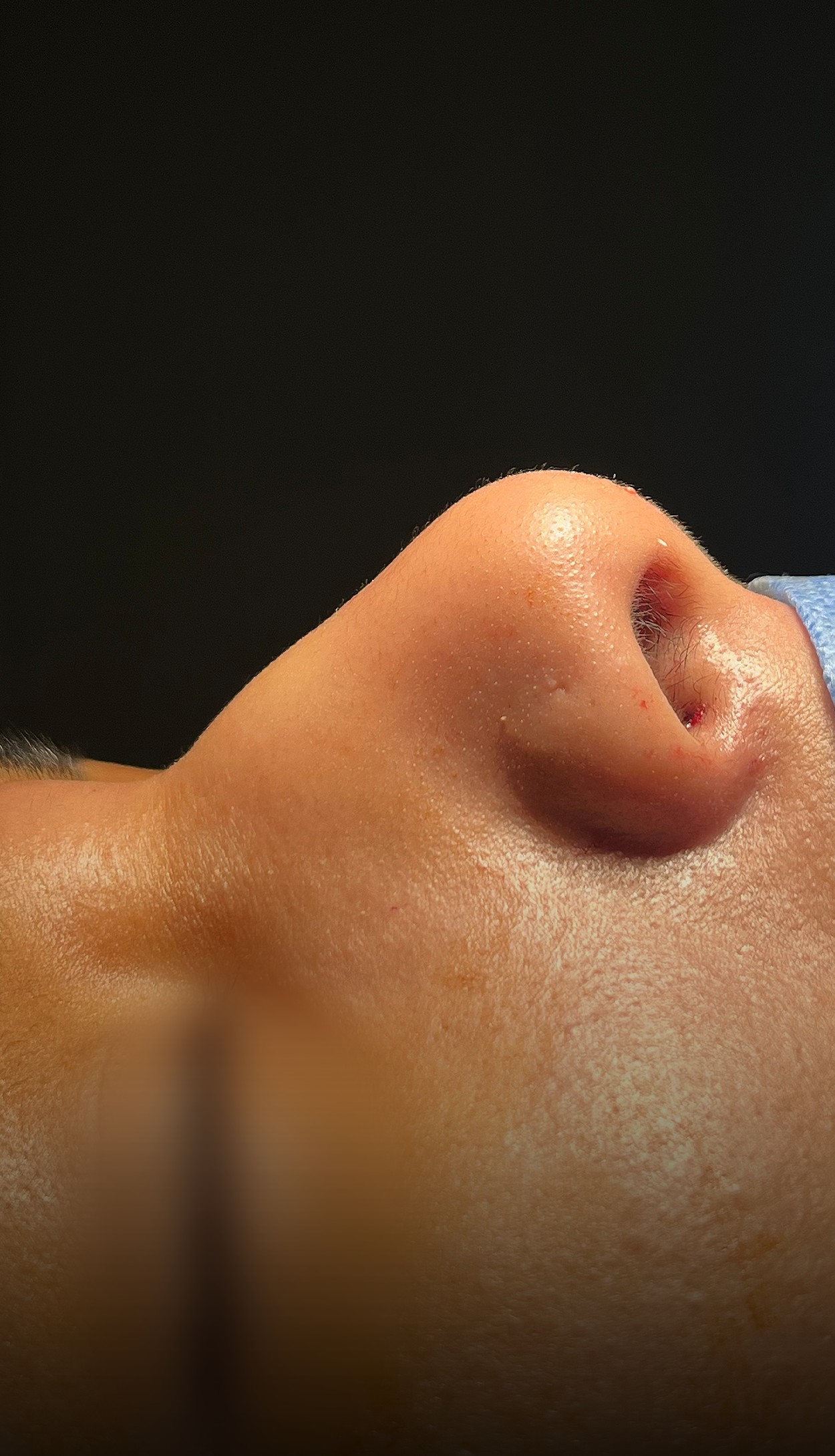 Comparación de perfil nasal antes y después del Caso 01 — antes