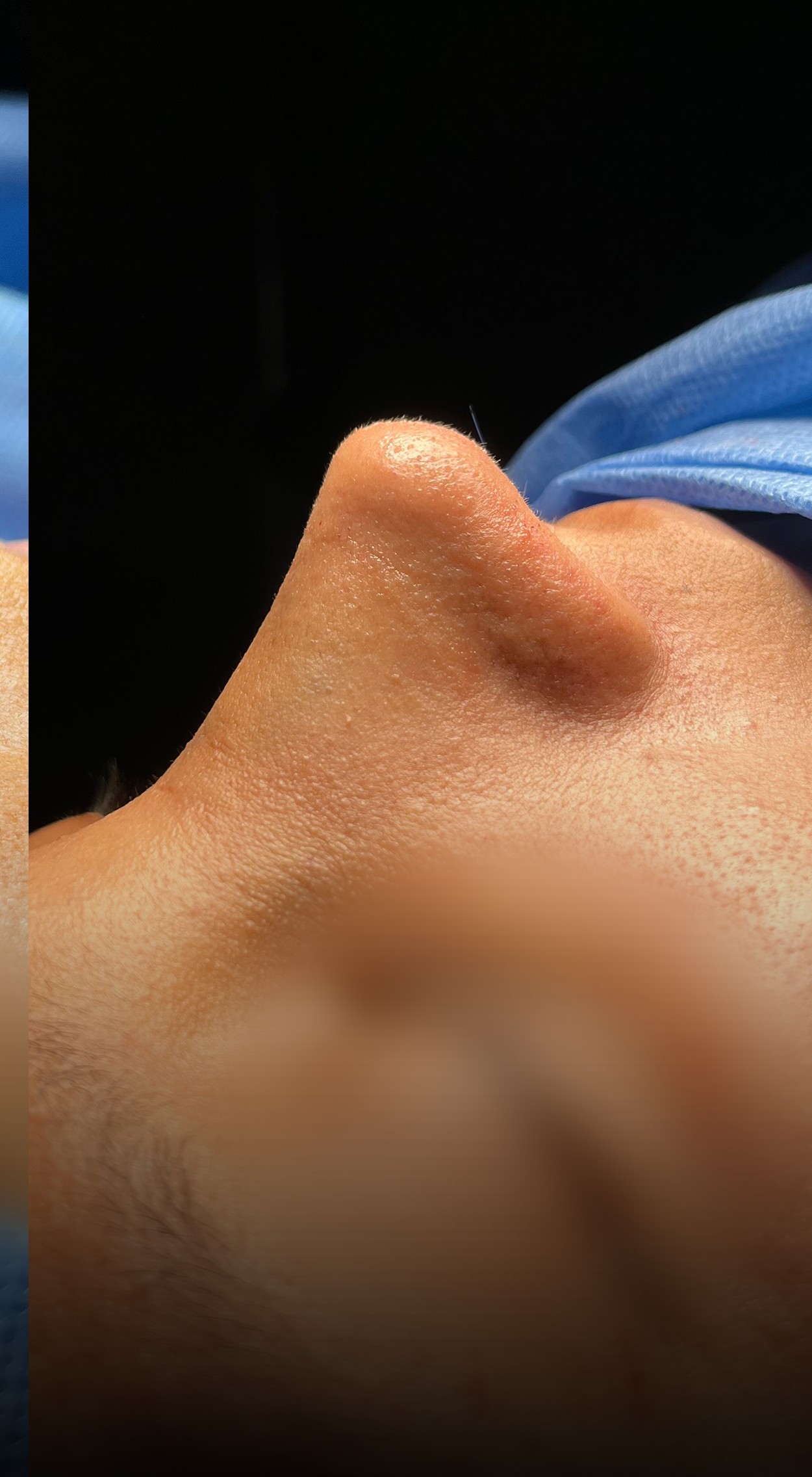 Comparación de perfil nasal antes y después del Caso 03 — después