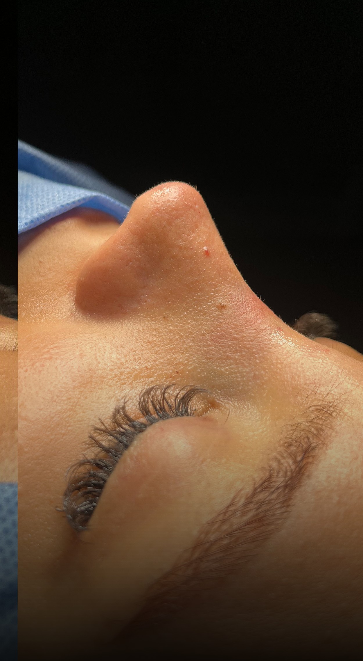 Comparación de perfil nasal antes y después del Caso 02 — después